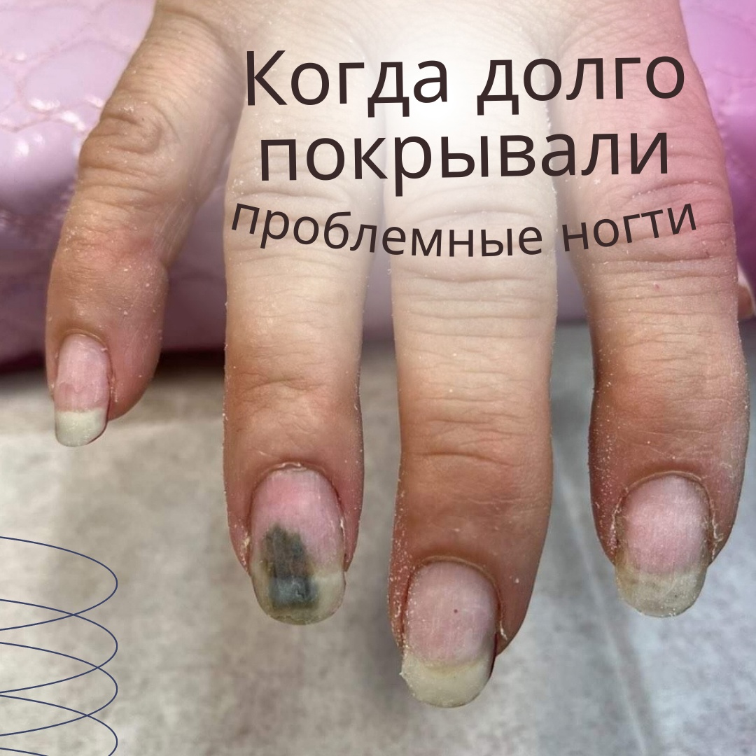 Inki profi стоп онихолизис. Онихолизисзис ногтей фото. Онихокриптоз ногтей фото.